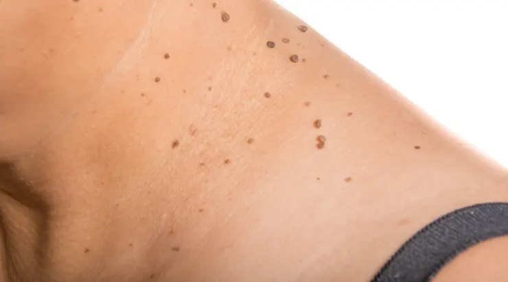 How to remove small warts from the skin